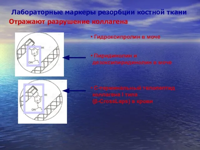 Лабораторные маркеры резорбции костной ткани Гидроксипролин в моче Пиридинолин и дезоксипиридинолин в