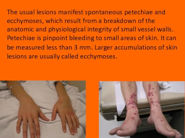 The usual lesions manifest spontaneous petechiae and ecchymoses, which result from a
