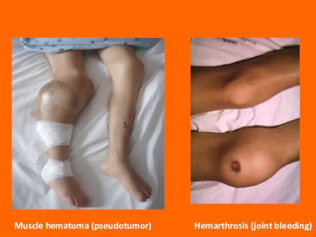Muscle hematoma (pseudotumor) Hemarthrosis (joint bleeding)
