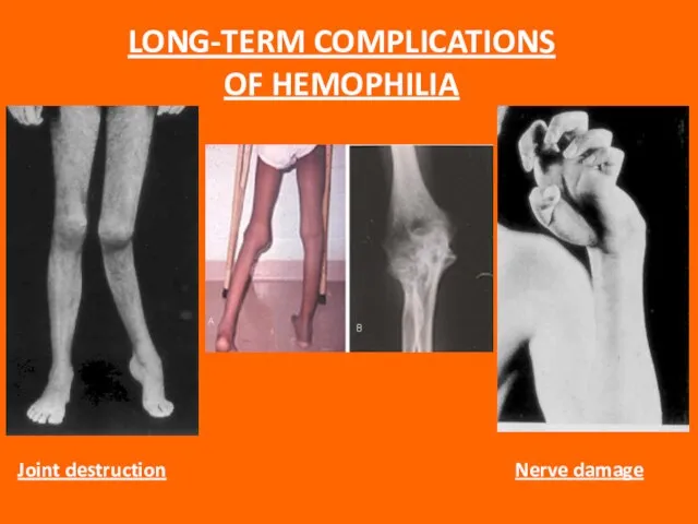 LONG-TERM COMPLICATIONS OF HEMOPHILIA