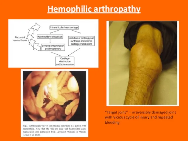Hemophilic arthropathy “Target joint” = irreversibly damaged joint with vicious cycle of injury and repeated bleeding