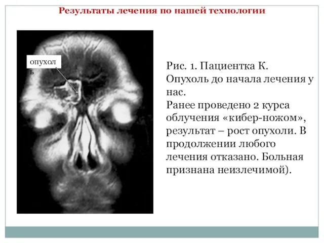 Рис. 1. Пациентка К. Опухоль до начала лечения у нас. Ранее проведено