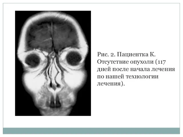 Рис. 2. Пациентка К. Отсутствие опухоли (117 дней после начала лечения по нашей технологии лечения).