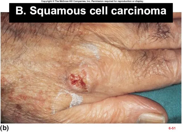 B. Squamous cell carcinoma 6-