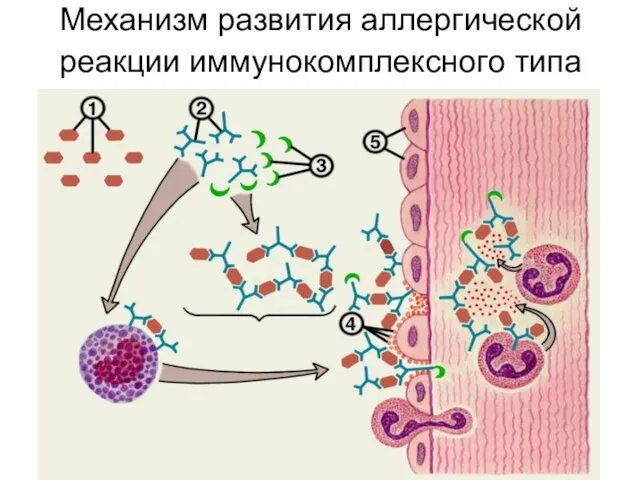 Механизм развития аллергической реакции иммунокомплексного типа