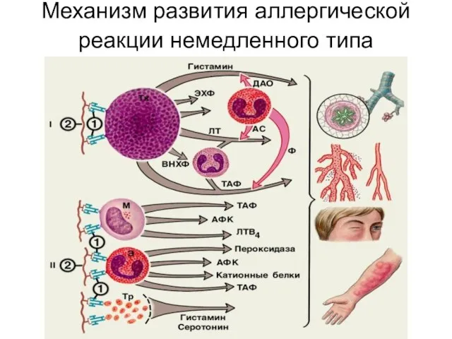 Механизм развития аллергической реакции немедленного типа