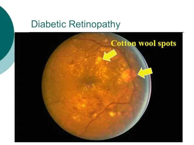 Diabetic Retinopathy Cotton wool spots