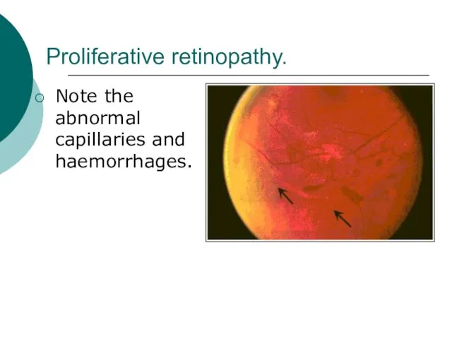 Proliferative retinopathy. Note the abnormal capillaries and haemorrhages.