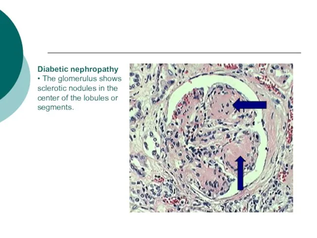 Diabetic nephropathy • The glomerulus shows sclerotic nodules in the center of the lobules or segments.