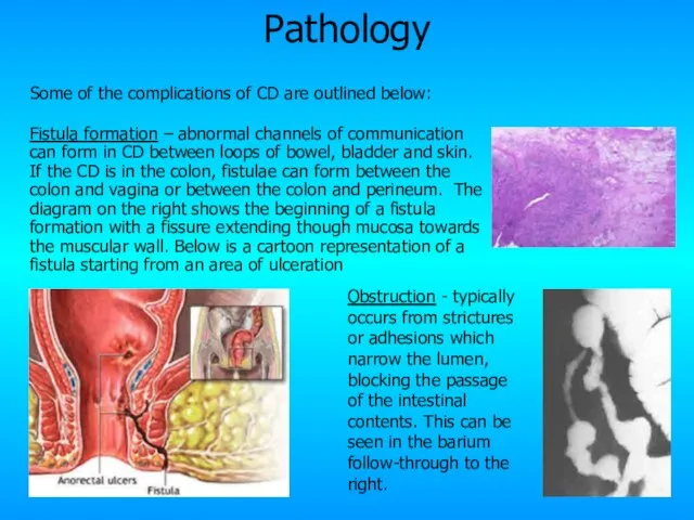 Pathology Some of the complications of CD are outlined below: Fistula formation