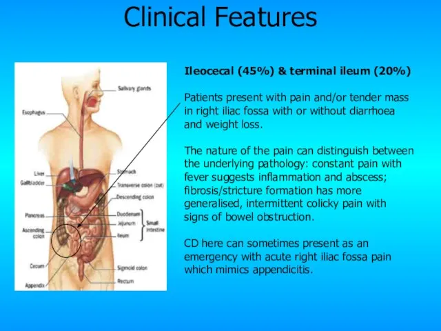 Ileocecal (45%) & terminal ileum (20%) Patients present with pain and/or tender