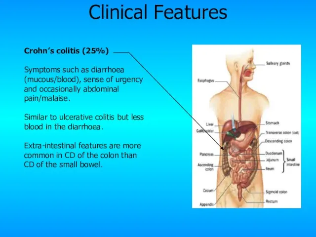 Crohn’s colitis (25%) Symptoms such as diarrhoea (mucous/blood), sense of urgency and