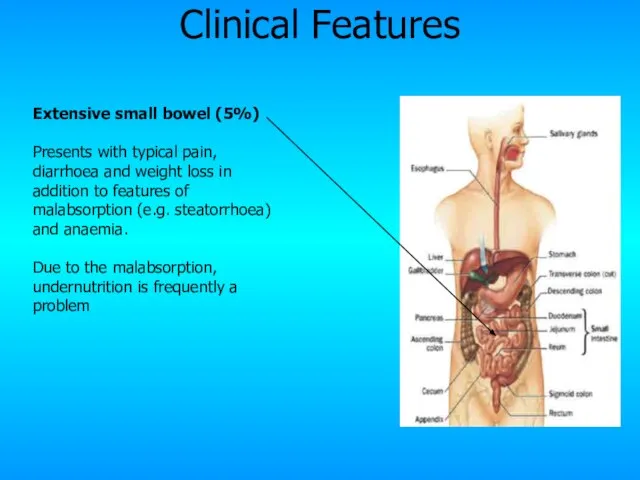Extensive small bowel (5%) Presents with typical pain, diarrhoea and weight loss