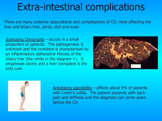 Extra-intestinal complications Sclerosing Cholangitis – occurs in a small proportion of patients.