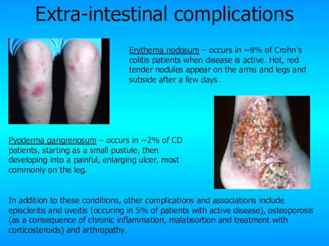Extra-intestinal complications Pyoderma gangrenosum – occurs in ~2% of CD patients, starting