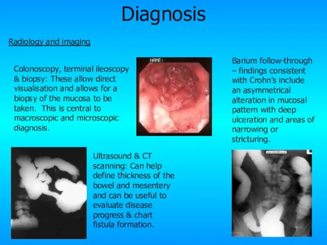 Diagnosis Radiology and imaging Ultrasound & CT scanning: Can help define thickness