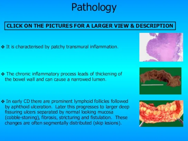 Pathology It is characterised by patchy transmural inflammation. The chronic inflammatory process