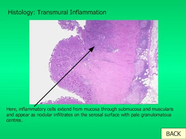 Histology: Transmural Inflammation Here, inflammatory cells extend from mucosa through submucosa and