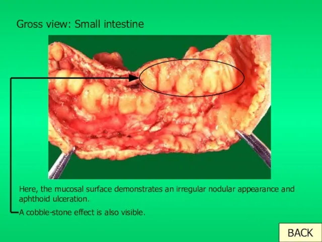 Gross view: Small intestine Here, the mucosal surface demonstrates an irregular nodular