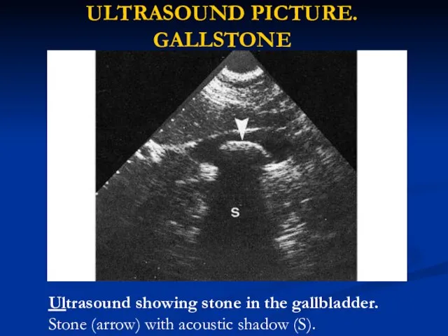 ULTRASOUND PICTURE. GALLSTONE Ultrasound showing stone in the gallbladder. Stone (arrow) with acoustic shadow (S).