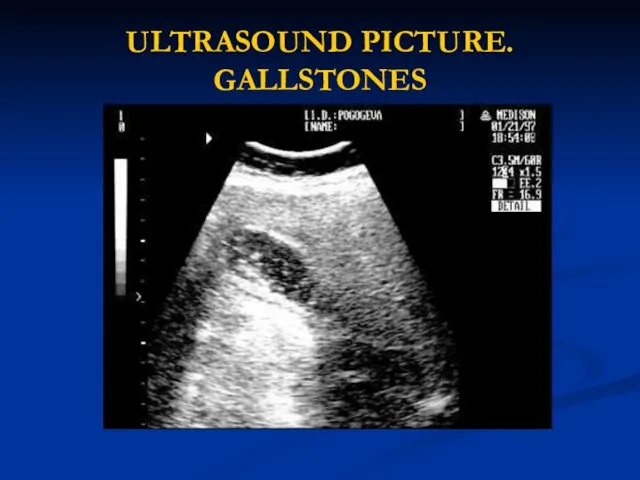 ULTRASOUND PICTURE. GALLSTONES