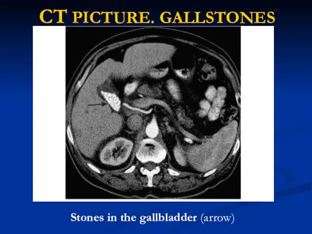 CT PICTURE. GALLSTONES Stones in the gallbladder (arrow)