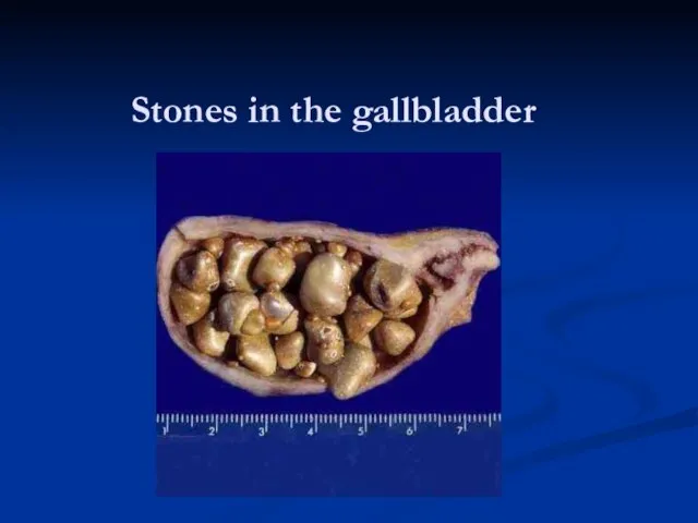 Stones in the gallbladder