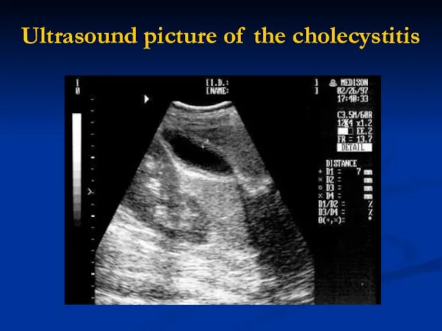 Ultrasound picture of the cholecystitis