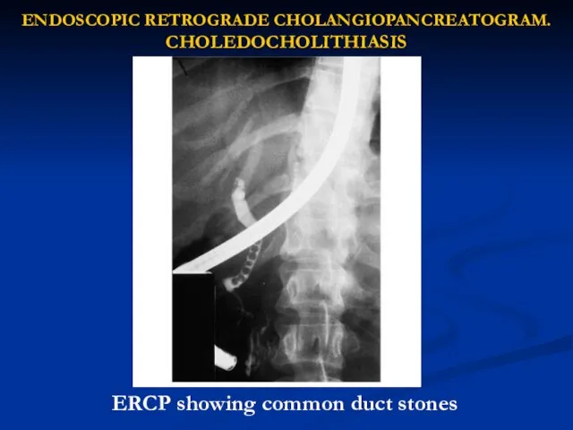 ENDOSCOPIC RETROGRADE CHOLANGIOPANCREATOGRAM. CHOLEDOCHOLITHIASIS ERCP showing common duct stones