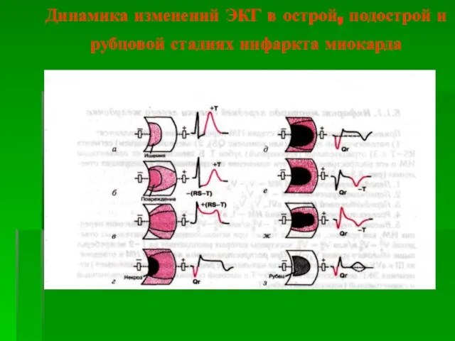 Динамика изменений ЭКГ в острой, подострой и рубцовой стадиях инфаркта миокарда