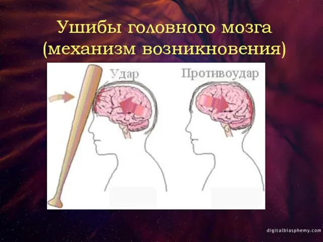 Ушибы головного мозга (механизм возникновения)