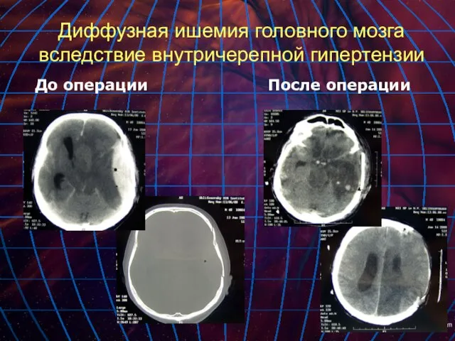 Диффузная ишемия головного мозга вследствие внутричерепной гипертензии До операции После операции