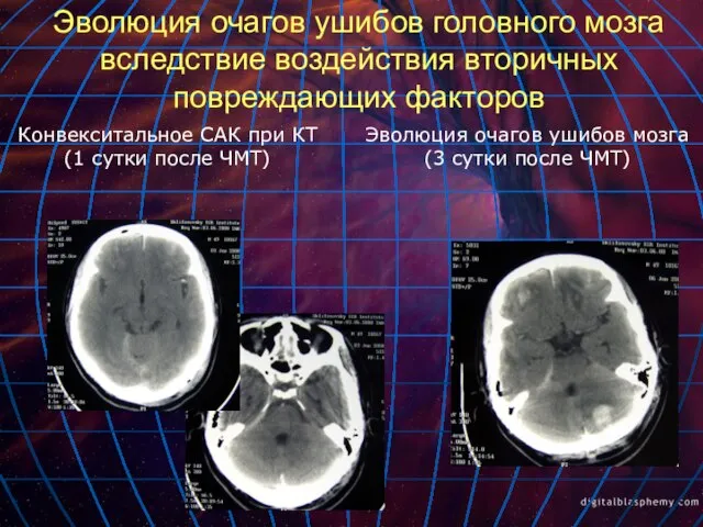 Эволюция очагов ушибов головного мозга вследствие воздействия вторичных повреждающих факторов Конвекситальное САК