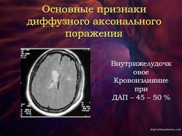 Основные признаки диффузного аксонального поражения Внутрижелудочковое Кровоизлияние при ДАП – 45 – 50 %