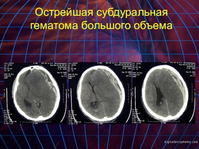 Острейшая субдуральная гематома большого объема