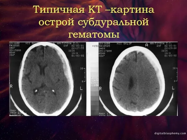 Типичная КТ –картина острой субдуральной гематомы