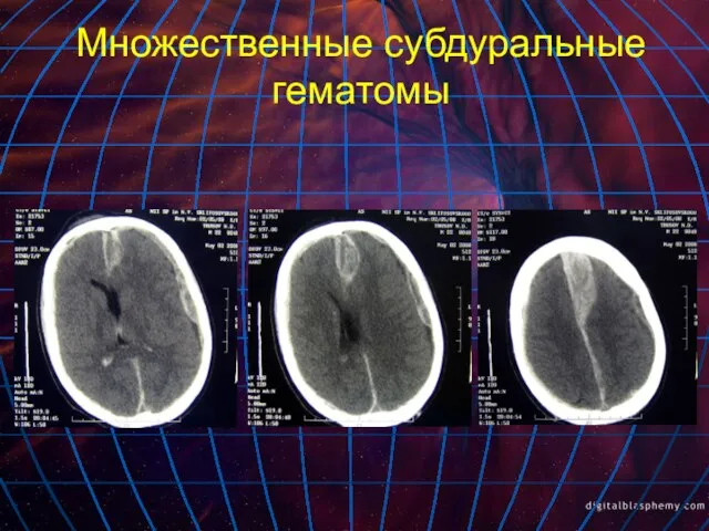 Множественные субдуральные гематомы