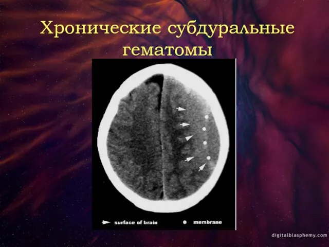 Хронические субдуральные гематомы