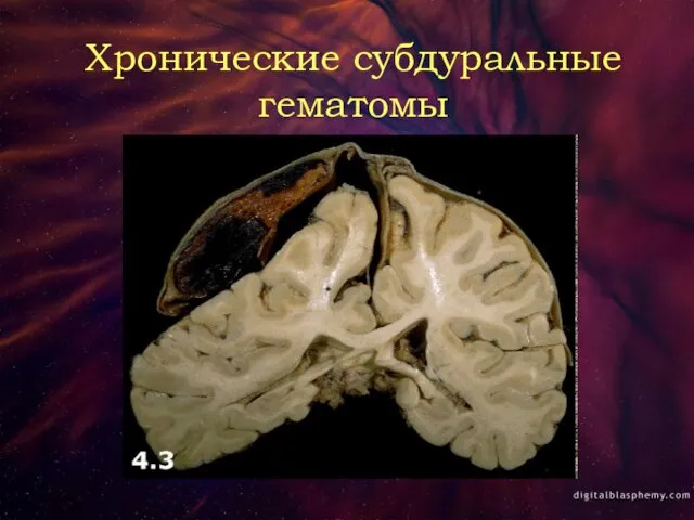 Хронические субдуральные гематомы