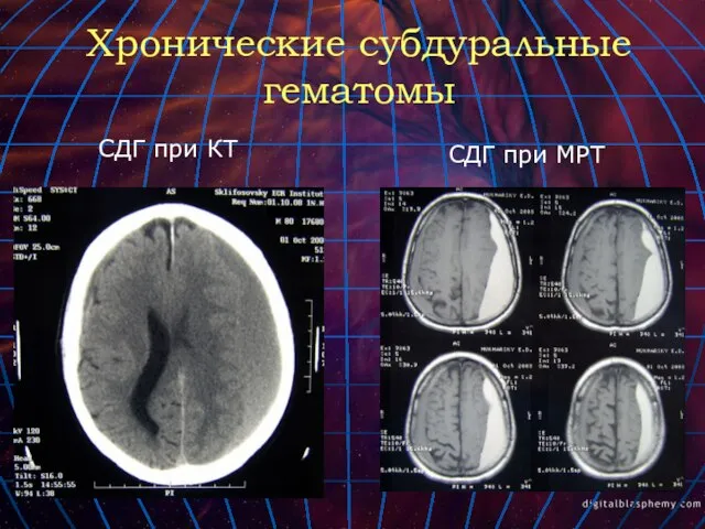 Хронические субдуральные гематомы СДГ при КТ СДГ при МРТ