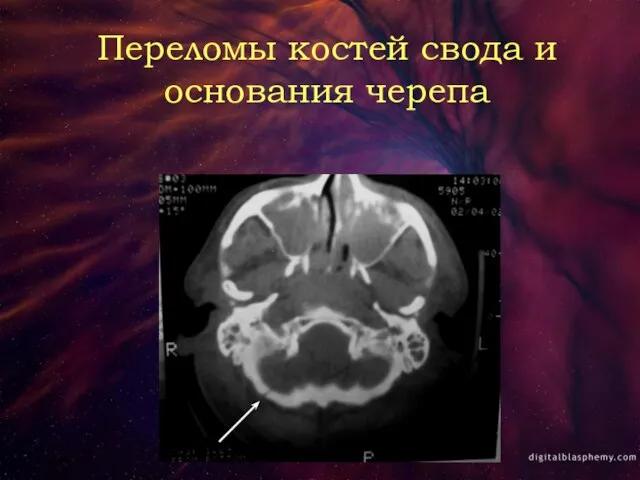 Переломы костей свода и основания черепа