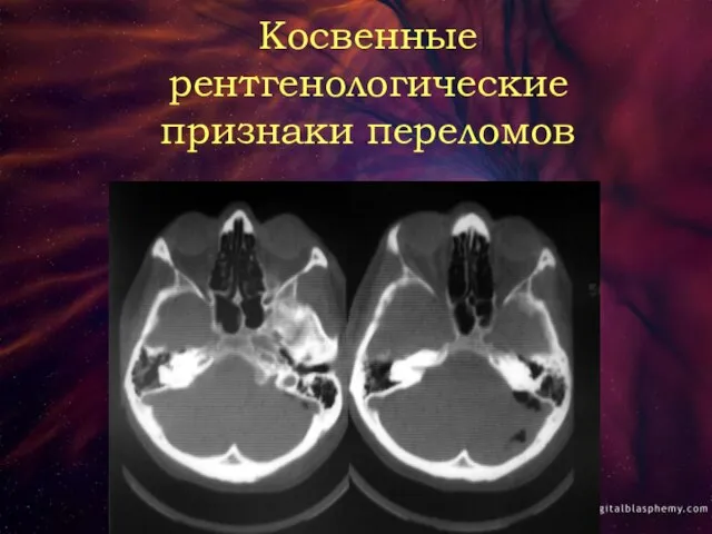 Косвенные рентгенологические признаки переломов