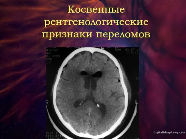 Косвенные рентгенологические признаки переломов