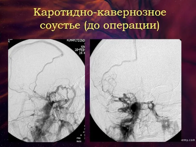 Каротидно-кавернозное соустье (до операции)