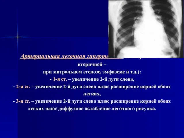 Артериальная легочная гипертензия (м.б. первичной и вторичной – при митральном стенозе, эмфиземе