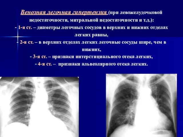 Венозная легочная гипертензия (при левожелудочковой недостаточности, митральной недостаточности и т.д.): - 1-я