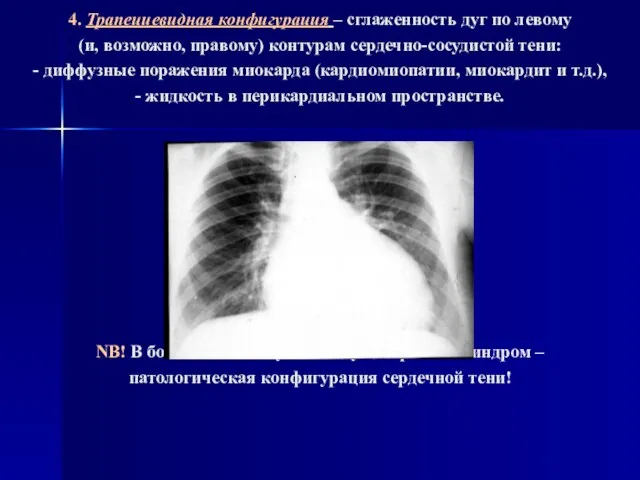 4. Трапециевидная конфигурация – сглаженность дуг по левому (и, возможно, правому) контурам