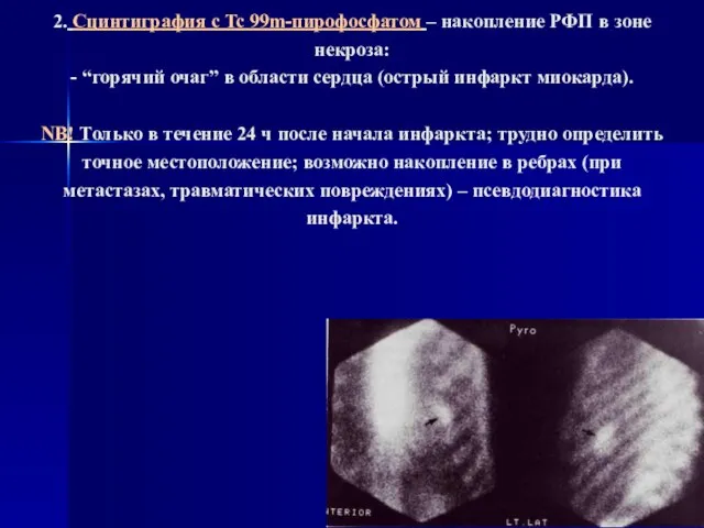 2. Сцинтиграфия с Tc 99m-пирофосфатом – накопление РФП в зоне некроза: -