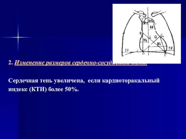 2. Изменение размеров сердечно-сосудистой тени. Сердечная тень увеличена, если кардиоторакальный индекс (КТИ) более 50%.