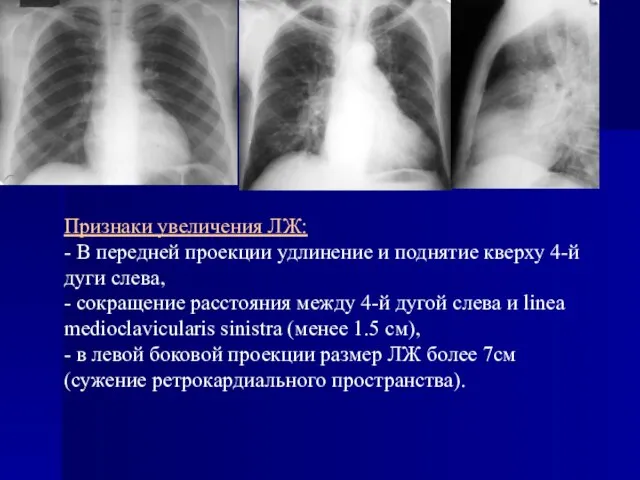 Признаки увеличения ЛЖ: - В передней проекции удлинение и поднятие кверху 4-й